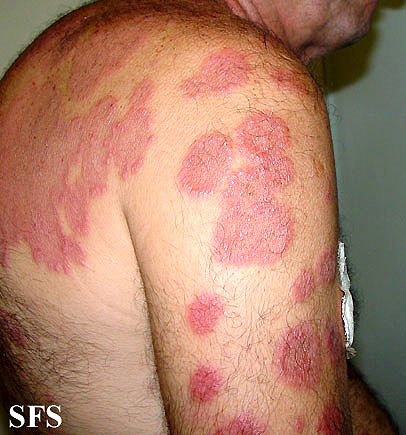 Sweet_syndrome_20.jpeg|400