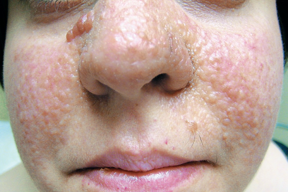 nejmicm1005598_f1.jpeg|400