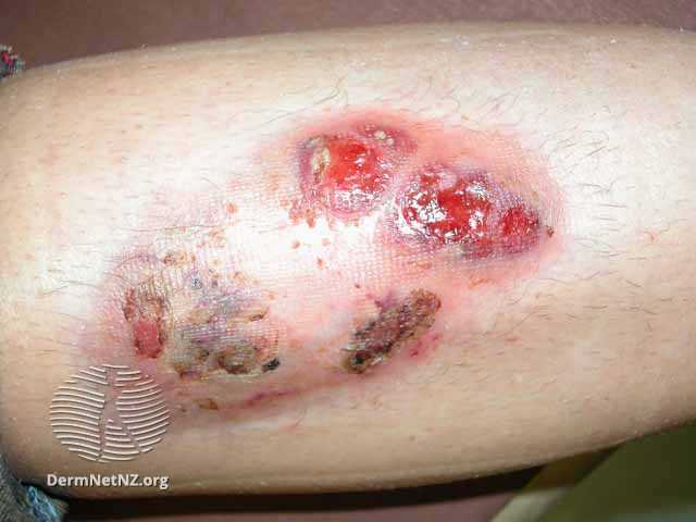 pyoderma-gangrenosum-0003__WatermarkedWyJXYXRlcm1hcmtlZCJd.jpg|300