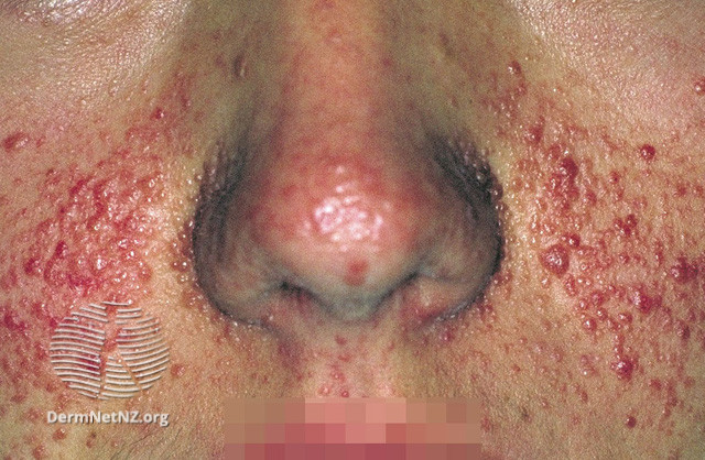 tubscler7__WatermarkedWyJXYXRlcm1hcmtlZCJd.jpg|400